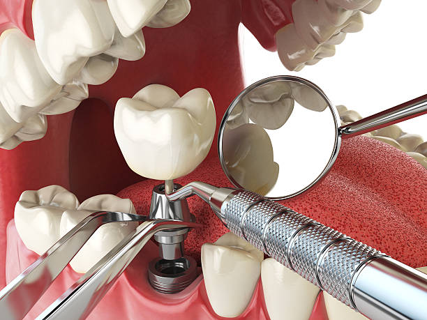 Best Knocked-Out Tooth Emergency  in Azusa, CA